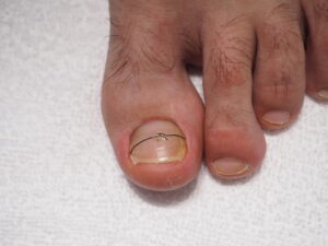 Nagelkorrektur mit Spange Nagelkorrektur mit Spange
