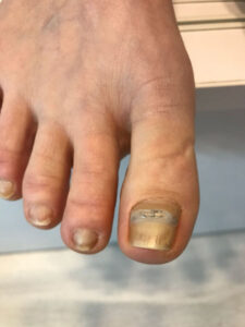 Podofix Nagelkorrektur Podofix Nagelkorrektur